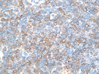 Ewing’s Sarcoma stained with CD99 antibody