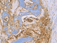 Colon cancer stained with CEA antibody