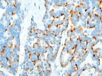 Neuroendocrine tumor stained with Chromogranin A antibody