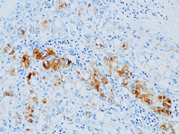 Hepatoma stained with Alpha-1-Fetoprotein