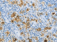 Hodgkin’s lymphoma stained with CD15 antibody