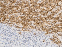 Anaplastic large cell lymphoma stained with CD30 antibody