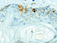 Skin stained with CD1a antibody