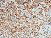 Leiomyosarcoma stained with Desmin antibody
