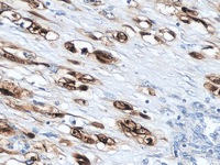 Rhabdomyosarcoma stained with Myoglobin antibody