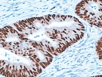 Colon cancer stained with p53 tumor suppressor antibody