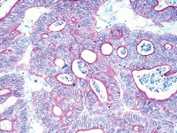 Colon cancer stained with Pan Cytokeratin antibody
