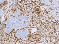 Liver cancer stained with Vimentin antibody