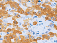 Anaplastic large cell lymphoma stained with ALKc antibody