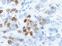 Breast cancer stained with Progesterone Receptor antibody