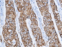 Breast cancer stained with Low Molecular Weight Cytokeratin antibody