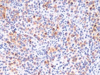 Melanoma stained with HMB45 antibody