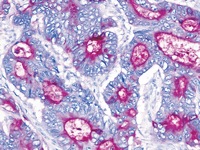 Colon cancer stained with CEA antibody