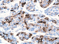 Breast cancer stained with pS2 antibody