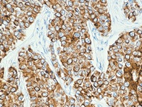 Breast cancer stained with CK7 antibody
