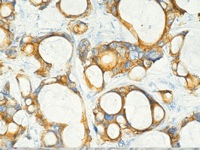 Colon cancer stained with Cytokeratin 20 antibody