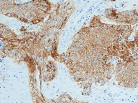 Squamous cell carcinoma in lung stained with EGFR antibody