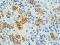Hodgkin’s lymphoma stained with CD15 antibody cocktail
