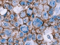 Anaplastic large cell lymphoma stained with CD30 antibody cocktail