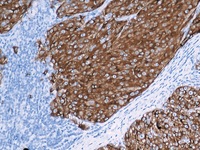 Melanoma stained with MART-1/Melan A antibody cocktail