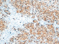 Melanoma stained with Melanoma antibody cocktail.