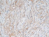 Dermatofibrosarcoma stained with CD34 antibody