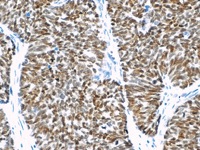 Lung cancer stained with TTF-1 antibody