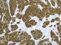 Melanoma stained with S100 Protein antibody cocktail