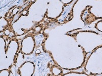 Mesothelioma stained with Calretinin antibody