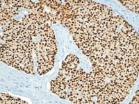 Breast cancer stained with Estrogen Receptor antibody