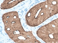 Colon cancer stained with Villin antibody.