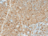 Mantle cell lymphoma stained with CD5 antibody