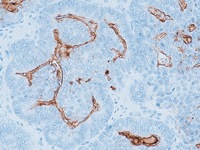 Ovarian cancer stained with CA 125 antibody