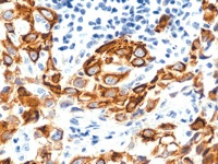 Mesothelioma stained with Cytokeratin 5/6 antibody
