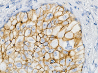 Breast cancer stained with Ber-EP4 antibody