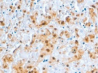 Herpes Simplex infected lung stained with HSV antibody