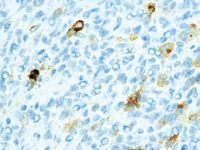 Hodgkins lymphoma stained with EBV antibody cocktail