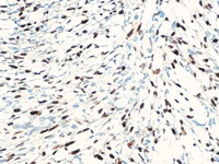 Rhabdomyosarcoma stained with Myogenin antibody