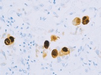 CMV infected tissue stained with Cytomegalovirus antibody