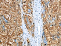 Colon cancer stained with CA 19-9 antibody