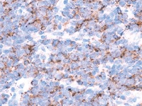 ALCL stained with TIA-1 antibody
