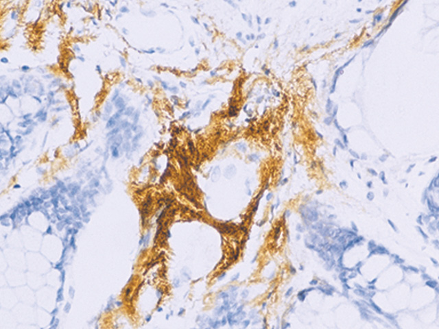 Amyloid P