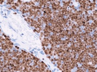 Lymphoblastic leukemia stained with TdT antibody.