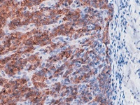 Breast cancer stained with EMA antibody