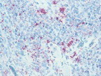 Infected lymph node stained with Cat Scratch antibody