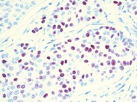 Breast cancer stained with PCNA antibody