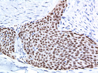 Lung squamous cell carcinoma stained with p63 antibody