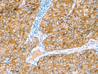 Melanoma stained with Pan Melanoma antibody cocktail
