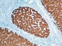 Liver cancer stained with HSA antibody