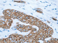 Breast cancer stained with E-cadherin
